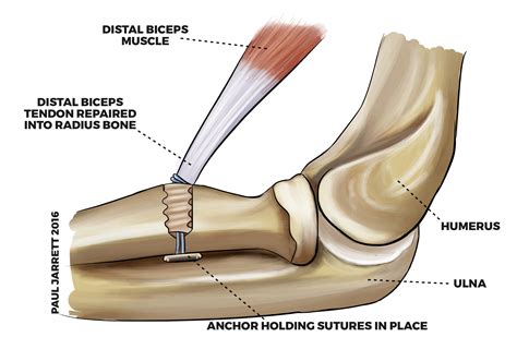 Distal Biceps Tendon Acute Distal Biceps Tendon Ruptures: Anatomy,