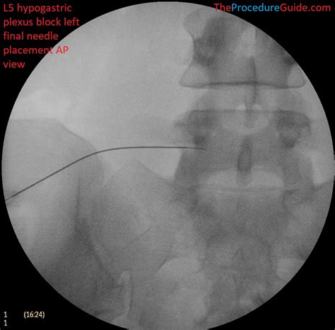 Fluoroscopy Injection 的图像结果