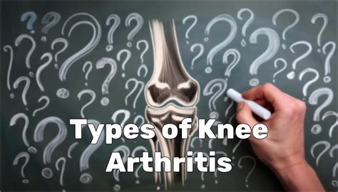 What Does Knee Arthritis Feel Like? | AposHealth®