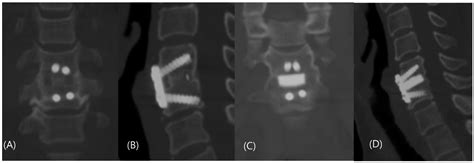 Anterior Cervical Discectomy and Fusion Performed Using a CaO-SiO2-P2O5 ...