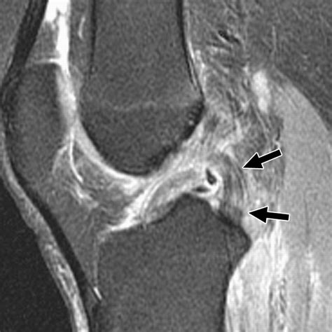 MRI Appearance of Posterior Cruciate Ligament Tears | AJR