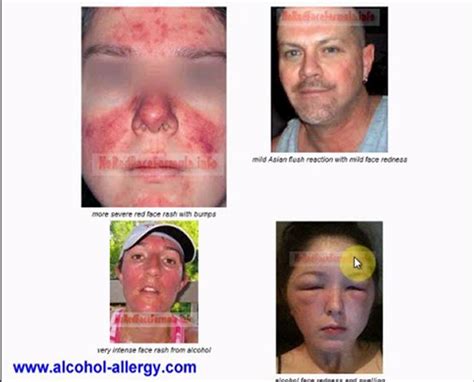 Alcohol Allergy And Intolerance: Rash, Hives, And Other Symptoms – OIDK