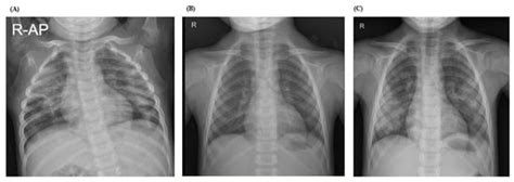 Children with Heiner Syndrome: A Single-Center Experience
