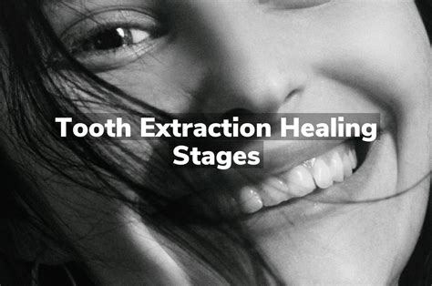 Post Tooth Extraction Healing 的图像结果