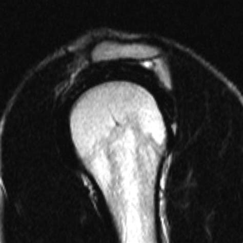 Acromion Types Mri Radiology