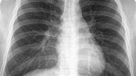 IIT Jodhpur Team Develops Covid Diagnosis Technique Using Chest X-Ray