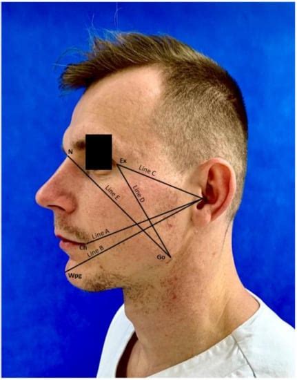 The Impact of Using Kinesio Tape on Non-Infectious Complications after ...