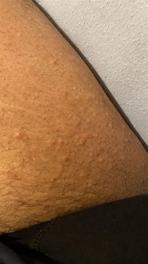 itchy bumps on my leg : r/DermatologyQuestions