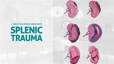 AIS Channel · 5 Things You Should Know about Splenic Trauma