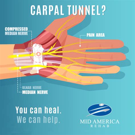 The Amazing Benefits of Physical Therapy for Carpal Tunnel Syndrome - Mid America Rehab