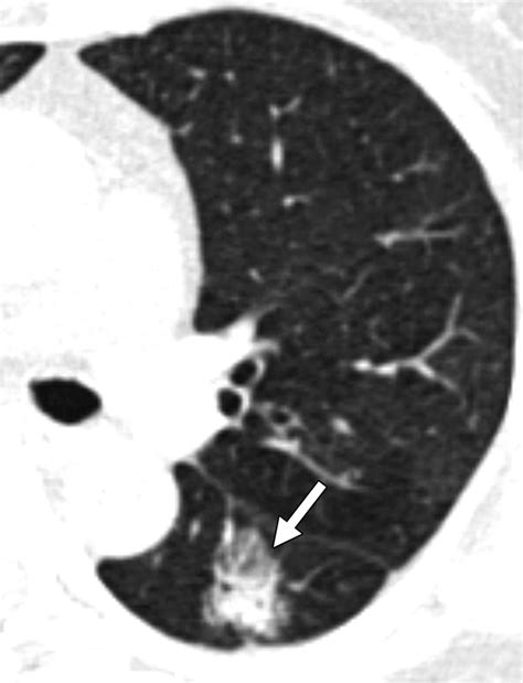Ground-Glass Nodules on Chest CT as Imaging Biomarkers in the Management of Lung Adenocarcinoma ...
