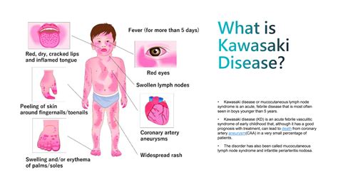 Kawasaki Disease details explain in this , what else to say in forty words.pptx