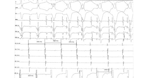Approach to Narrow QRS Tachycardia