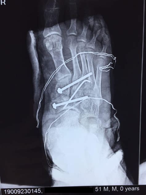 Fracture dislocation of medial cuneiform along with lisfranc injury: A ...