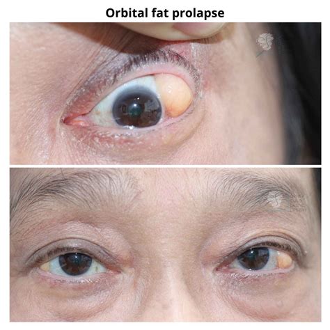 Orbital fat prolapse - Dr Anthony Maloof