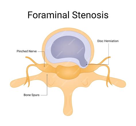 Severe Foraminal Stenosis