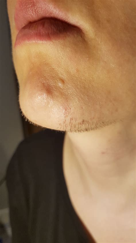 Electrolysis on PCOS girl - Electrolysis manufacturers - Hairtell hair removal forum by Andrea James