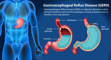 GERD: Acid Reflux Symptoms, Causes, And Treatment