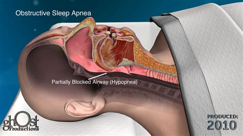 Apnex - Hypoglossal Nerve Stimulation (HGNS®) System | Video