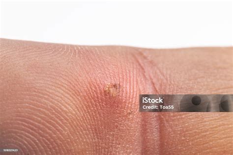 Image result for Splinter in Hand