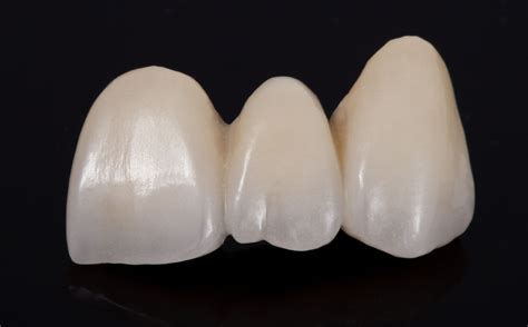 Anterior 3 unit porcelain fused to metal bridge | Dental art, Dental ...