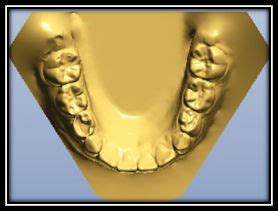Image result for How to Take Study Models with Plaster Lab