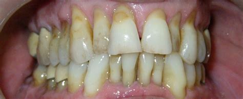 Toothache 的图像结果