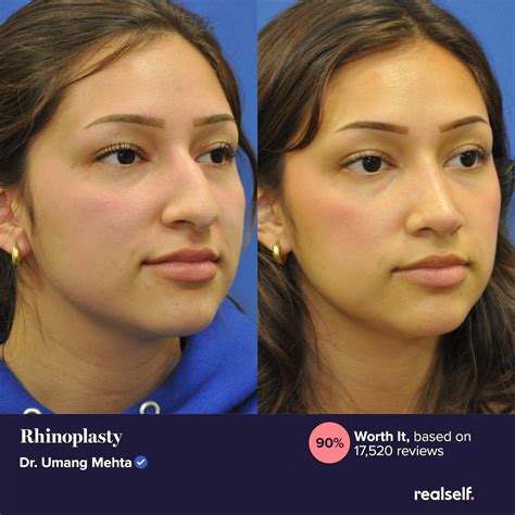 What Is The Average Cost Of Rhinoplasty In 2026?