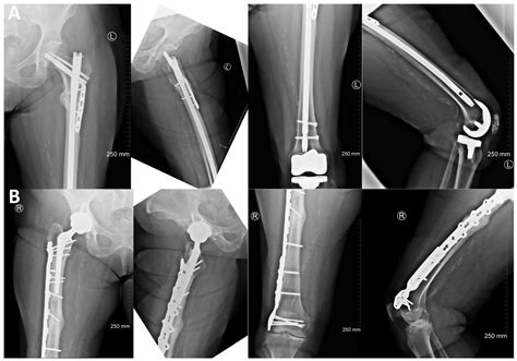 Bilateral Atypical Femoral Fracture in a Bisphosphonate-Naïve Patient ...