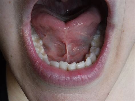 Adult Tongue Tie: What You Need to Know — Pain Free Dentist Sydney