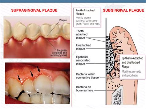 DENTAL PLAQUE - PART 1 | PPTX