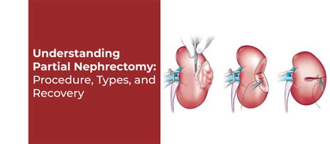 Image result for Open Nephrectomy Procedure