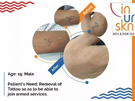Laser Tattoo Removal in Mumbai at Competitive Prices | Inurskn