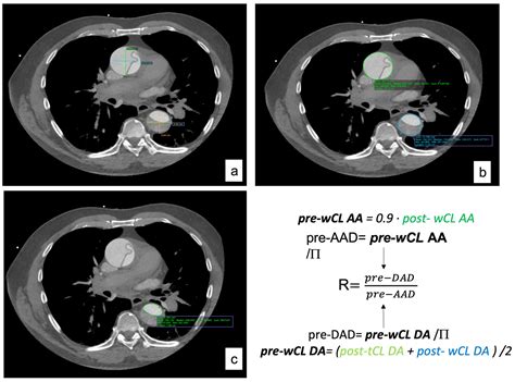 Aortic Dilatation on the Edge of Dissection—Do We Operate Too Late? The Ratio between Ascending ...