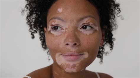 What is 'Vitiligo'? | rocketcitynow.com