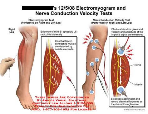 Image result for EMG Back Test