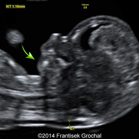 12 Week Ultrasound Down Syndrome Pictures