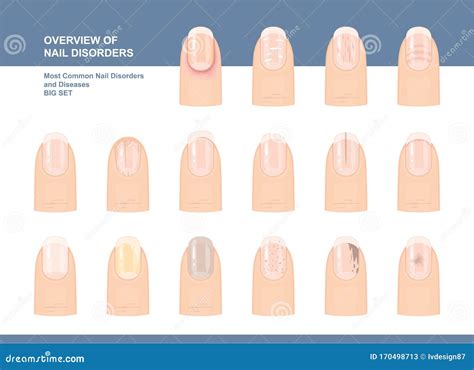 Understanding The Most Common Diseases Of Nails And Their Treatments