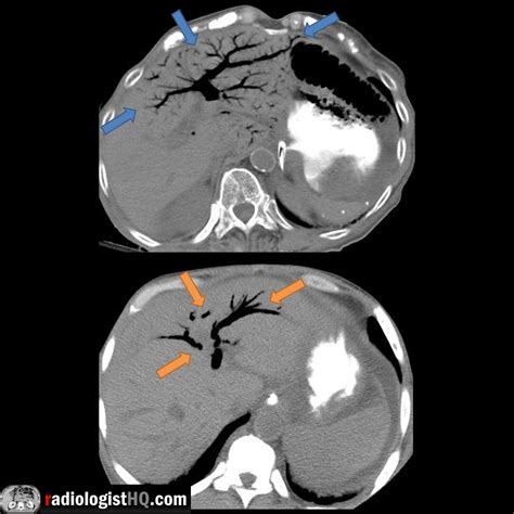 Intrahepatic portal venous gas vs. pneumobilia on CT : r/Radiology