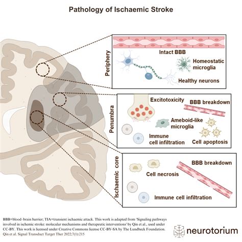 Figure 1 From Pathophysiology Of Acute Ischaemic Stroke Mechanisms,