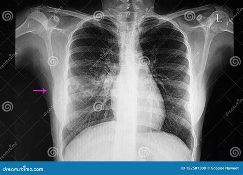 Lobar Pneumonia Chest X Ray Lobar Pneumonia Vs Bronchopneumonia