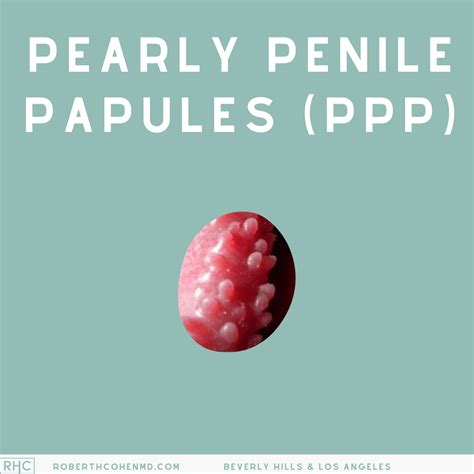 Bumps on your penis? Understanding Pearly Penile Papules (PPP) - Robert H. Cohen MD