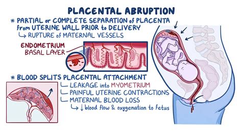 Placental abruption: Video & Meaning | Osmosis