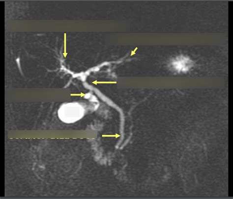 Image result for MRCP Biliary Tree