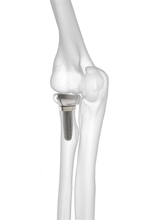 Prosthetic Radial Head 的图像结果
