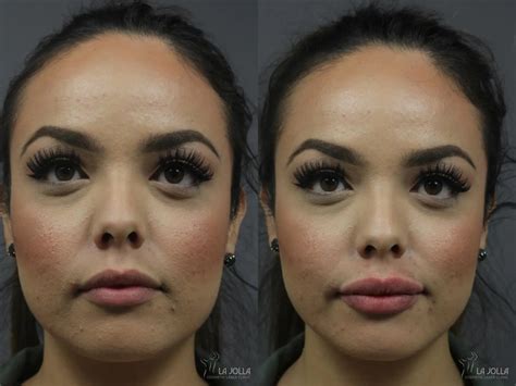 Lip Filler Before & After Gallery: Patient 7