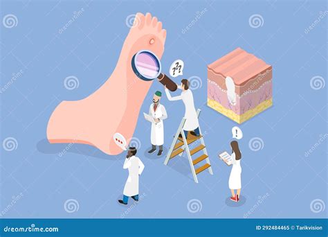 3D Isometric Flat Vector Conceptual Illustration of Foot Wart Stock ...