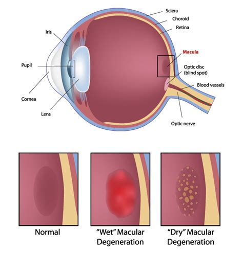 Image result for Macular Degeneration Example