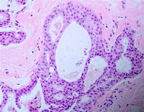 Pathology Outlines - Atypical ductal hyperplasia