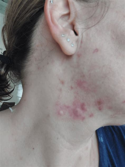 Persistent hormonal acne from Kyleena IUD even after removal : r/acne